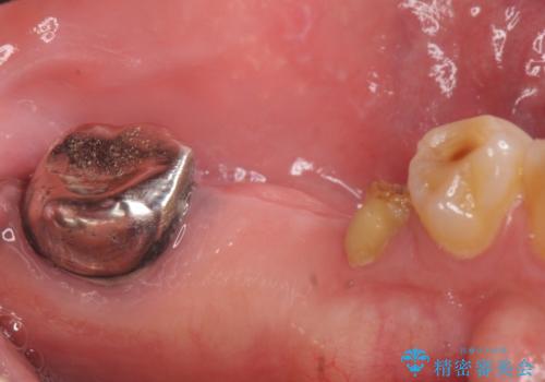 インプラント 失った奥歯の欠損補綴の治療前