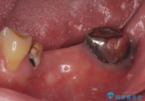 インプラント 失った奥歯の欠損補綴の治療前