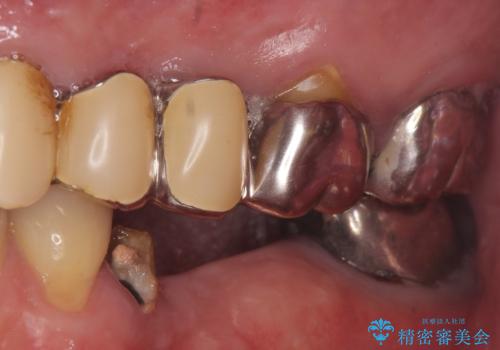 インプラント 失った奥歯の欠損補綴の治療前