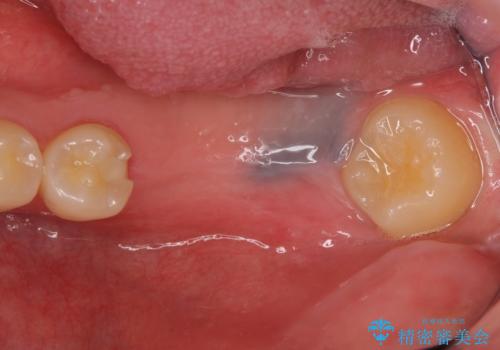 インプラント 失ってしまった奥歯の再建の治療前