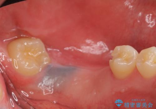 インプラント 失ってしまった奥歯の再建の治療前