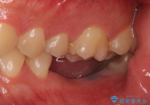 インプラント 失ってしまった奥歯の再建の治療前