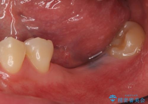 インプラント 失ってしまった奥歯の再建の治療前