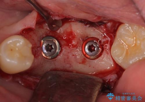 インプラント 失ってしまった奥歯の再建の治療中