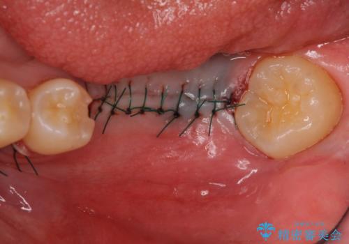 インプラント 失ってしまった奥歯の再建の治療後