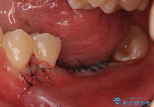 インプラント 失ってしまった奥歯の再建の治療後
