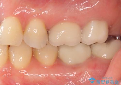 銀歯がしみる PGA(ゴールド)インレーへ 40代女性の治療前