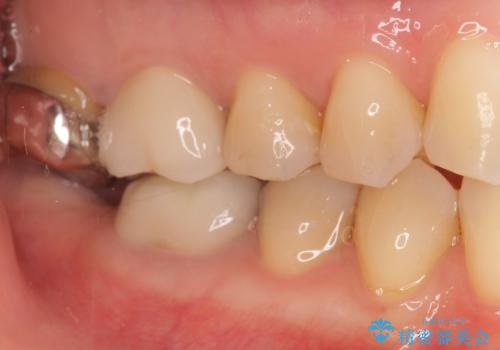 銀歯がしみる PGA(ゴールド)インレーへ 40代女性の治療前