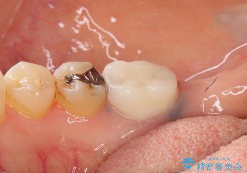 銀歯がしみる PGA(ゴールド)インレーへ 40代女性の治療前
