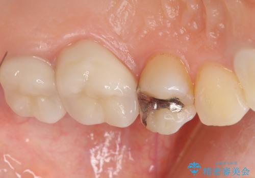 銀歯がしみる PGA(ゴールド)インレーへ 40代女性の治療前