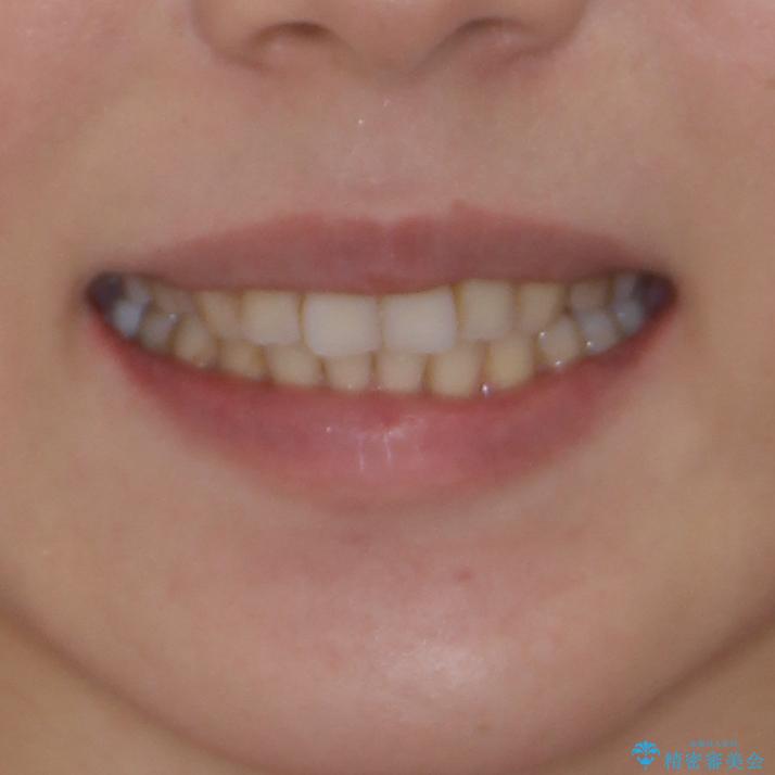 総合歯科治療　矯正治療と失活歯のセラミック補綴治療の治療後（顔貌）