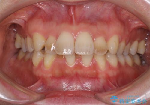 閉じにくい口元　前歯を引っ込める抜歯矯正の症例 治療前