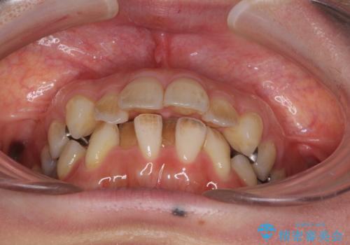 閉じにくい口元 前歯を引っ込める抜歯矯正の治療前