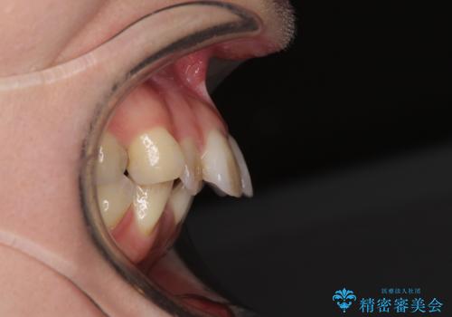 閉じにくい口元 前歯を引っ込める抜歯矯正の治療前