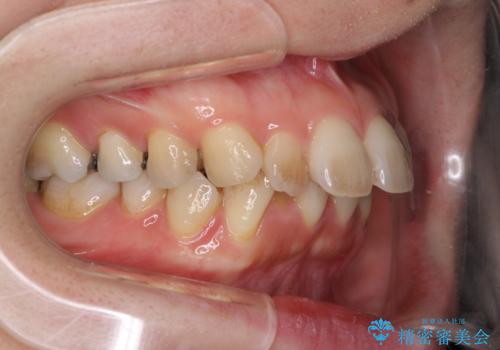閉じにくい口元 前歯を引っ込める抜歯矯正の治療前