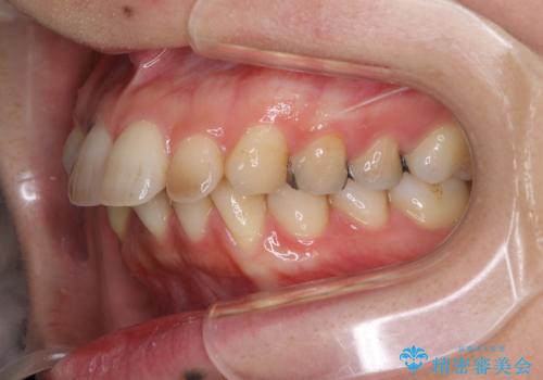 閉じにくい口元　前歯を引っ込める抜歯矯正の治療前