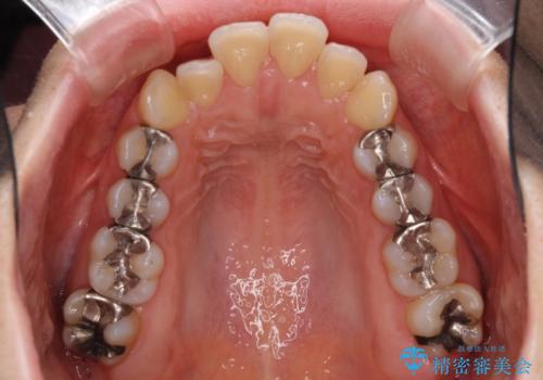 閉じにくい口元　前歯を引っ込める抜歯矯正の治療前