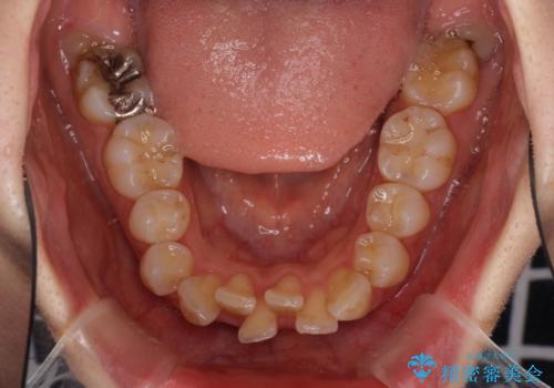 閉じにくい口元 前歯を引っ込める抜歯矯正の治療前