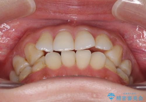 総合歯科治療　矯正治療と失活歯のセラミック補綴治療の治療前