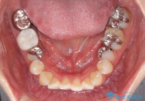 総合歯科治療　矯正治療と失活歯のセラミック補綴治療の治療前