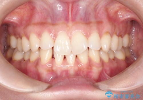 前歯のがたつきと隙間の矯正 インビザラインにての症例 治療前
