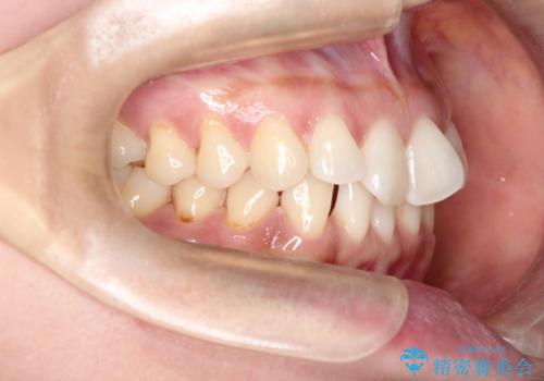 前歯のがたつきと隙間の矯正 インビザラインにての治療前