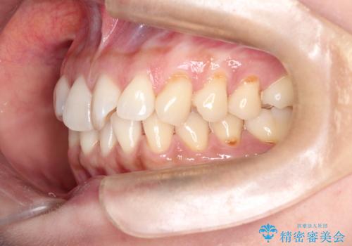 前歯のがたつきと隙間の矯正 インビザラインにての治療前