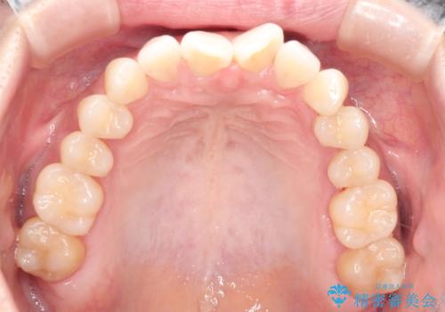 前歯のがたつきと隙間の矯正 インビザラインにての治療前