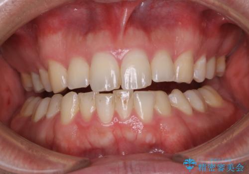 PMTCで見た目を綺麗にの症例 治療前