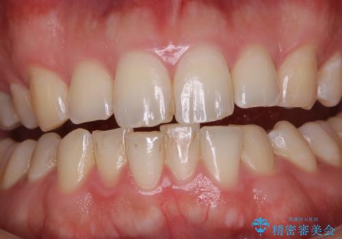 PMTCで見た目を綺麗にの治療前