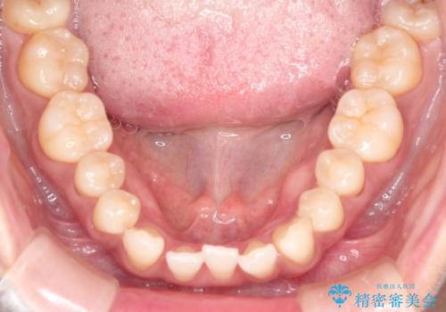 前歯のがたつきと隙間の矯正　インビザラインにての治療前