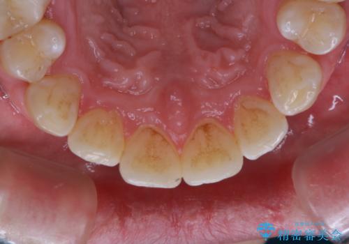 PMTCで見た目を綺麗にの治療前