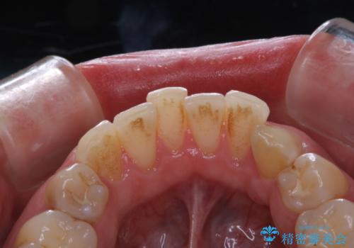 PMTCで見た目を綺麗にの治療前