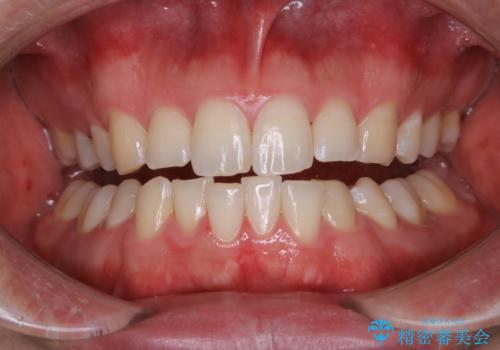 PMTCで見た目を綺麗にの症例 治療後