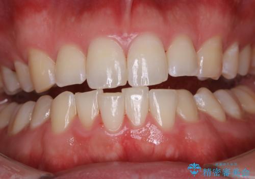 PMTCで見た目を綺麗にの治療後