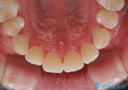 PMTCで見た目を綺麗にの治療後