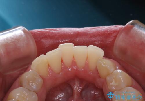 PMTCで見た目を綺麗にの治療後