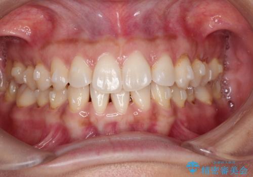 前歯のがたつきと隙間の矯正 インビザラインにての治療中