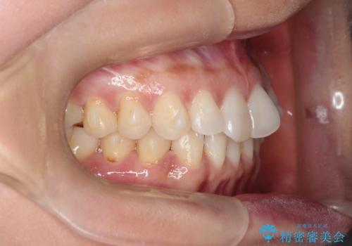 前歯のがたつきと隙間の矯正 インビザラインにての治療中