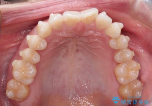 前歯のがたつきと隙間の矯正 インビザラインにての治療中