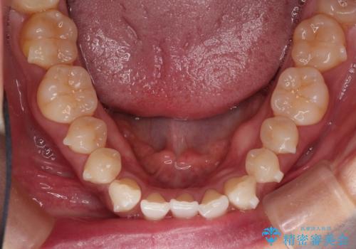 前歯のがたつきと隙間の矯正 インビザラインにての治療中