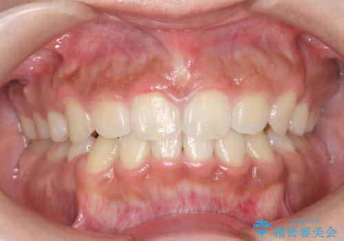 矯正治療後、ホワイトニングで歯の色を白くしてさらに口元を美しく!の症例 治療前