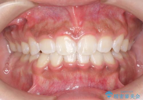 矯正治療後、ホワイトニングで歯の色を白くしてさらに口元を美しく!の症例 治療後