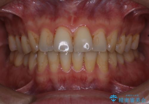 歯のお掃除　PMTCの症例 治療前