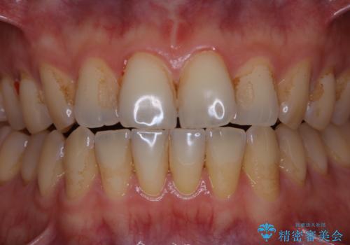 歯のお掃除 PMTCの治療前