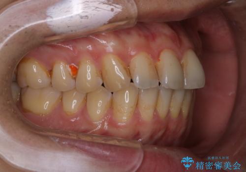 歯のお掃除 PMTCの治療前