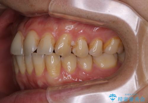 歯のお掃除 PMTCの治療前