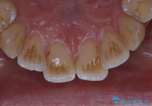 歯のお掃除 PMTCの治療前