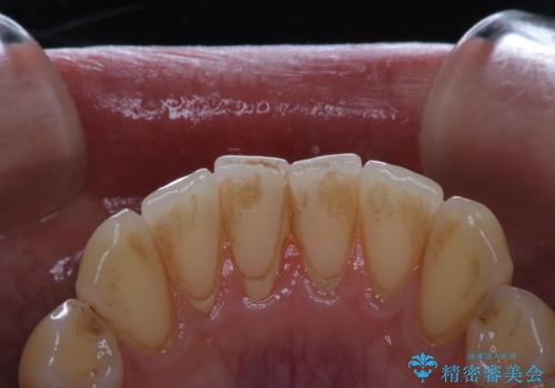 歯のお掃除 PMTCの治療前