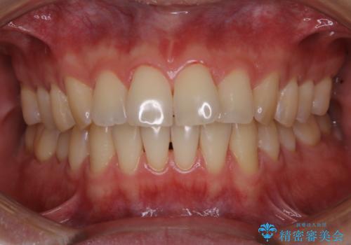 歯のお掃除　PMTCの症例 治療後